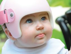 “سندروم سر صاف” یا “پلاژیوسفالی موضعی” در نوزادان چیست؟ (قسمت اول)