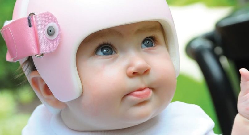 “سندروم سر صاف” یا “پلاژیوسفالی موضعی” در نوزادان چیست؟ (قسمت اول)