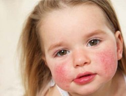 حساسیت (آلرژی) های غذایی در کودکان را بشناسید (قسمت دوم)