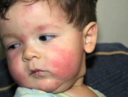 آلرژی غذایی در کودکان چیست و چه نشانه هایی دارد؟ – بخش اول