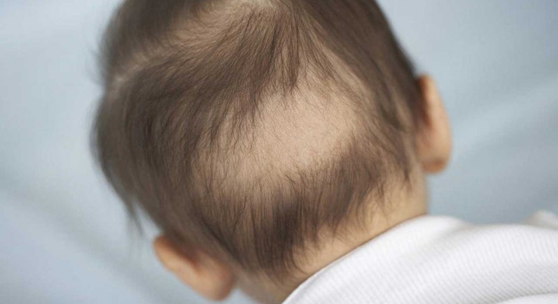 آیا از علل ریزش مو در نوزادان خود با خبرید؟